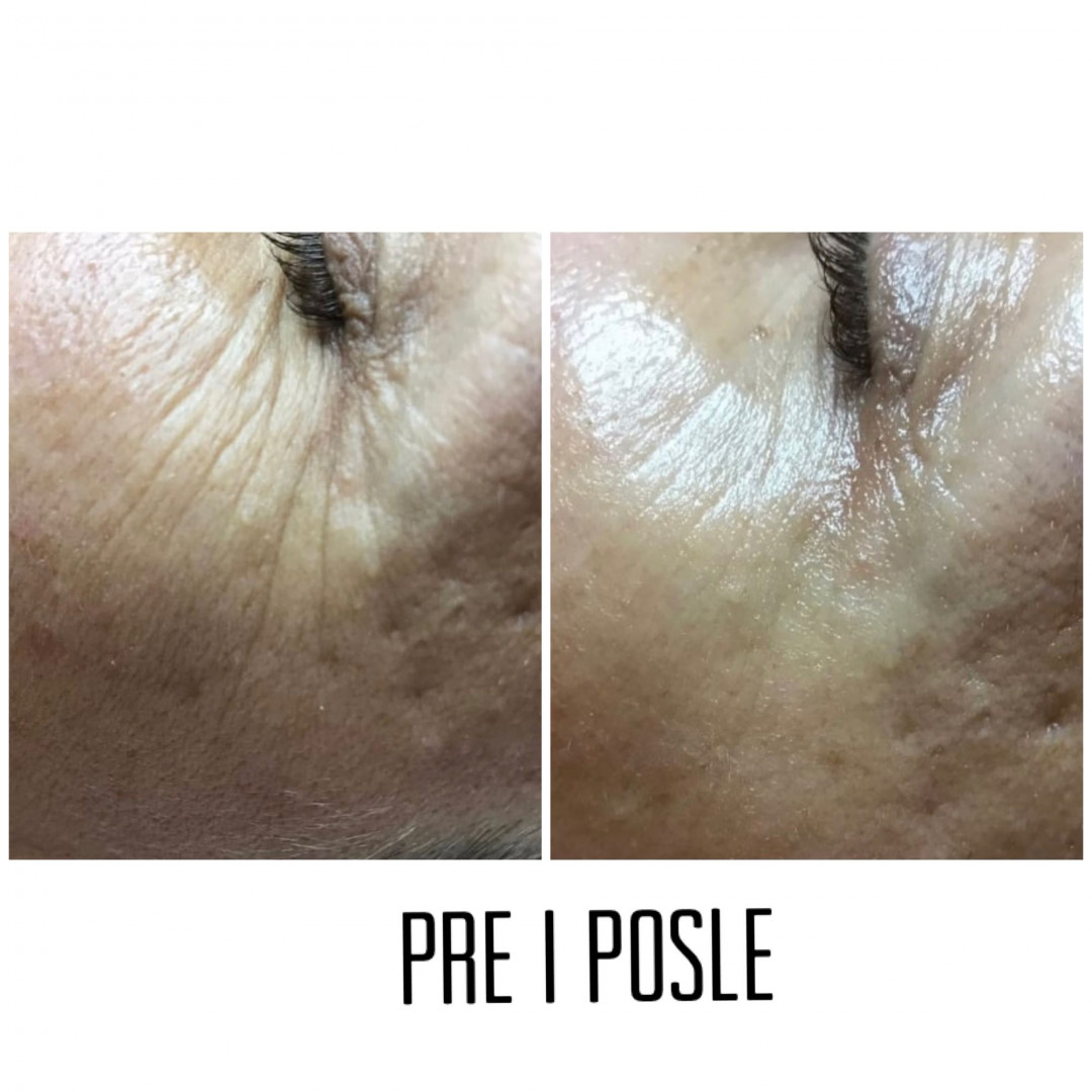 Bellagio beauty center #beograd Tretman lica 3D Anti age tretman - zamena za hijaluron / botox / PRP