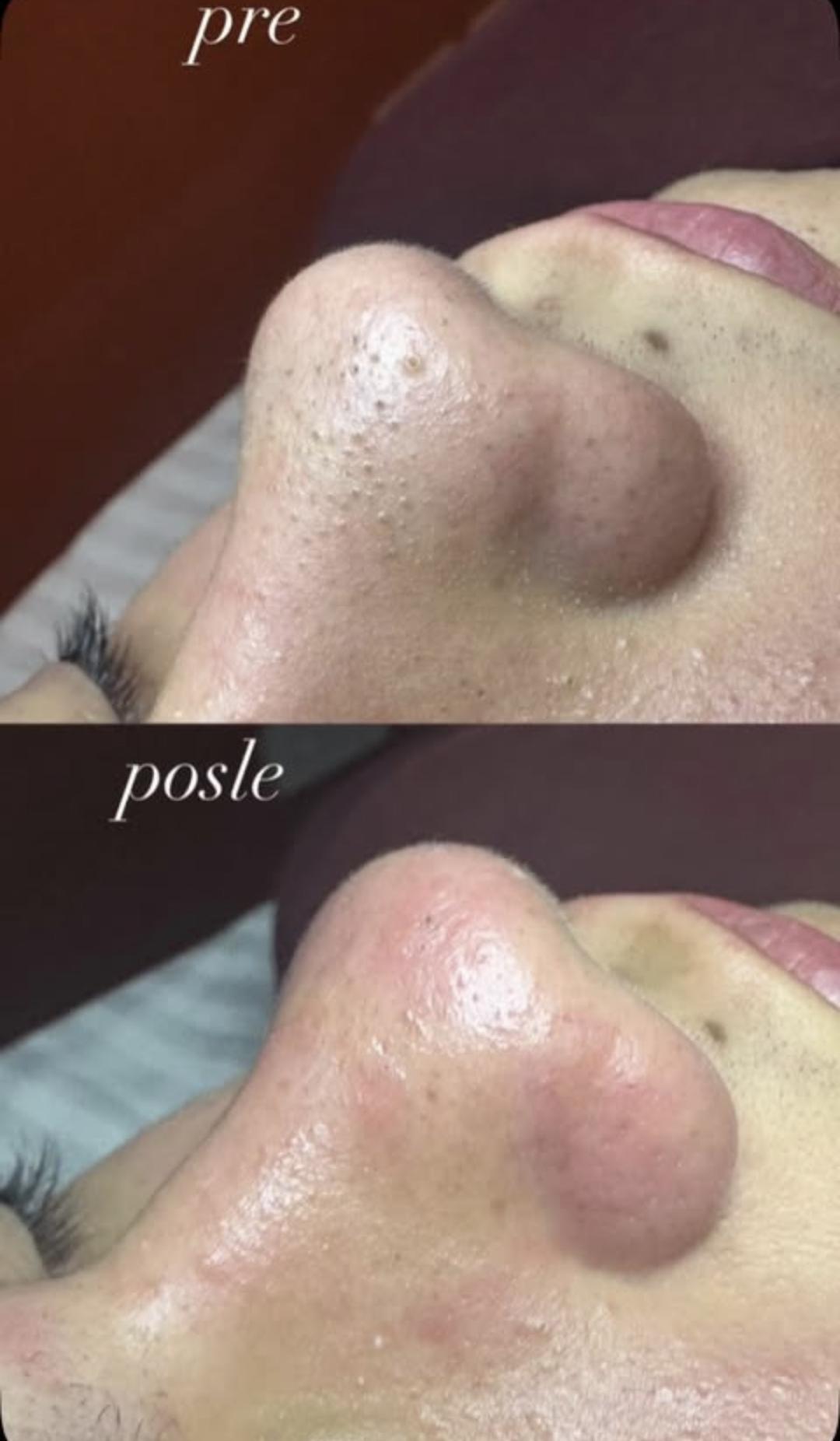 Higijenski tretman lica - osnovni - Beautique spa, Beograd Tretman lica Lice Tretman lica, Beograd, Novi Beograd blokovi, Belville, Savski kej