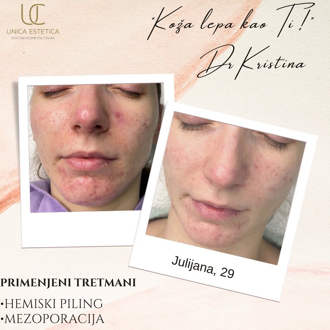 Unica Estetica #nis Tretman lica Hemijski piling mandeličnom kiselinom