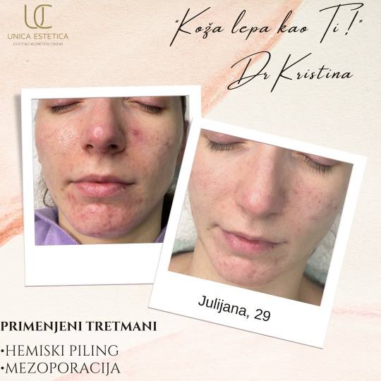 Unica Estetica #nis Tretman lica Hemijski piling mandeličnom kiselinom Jucina koža je bila prilič