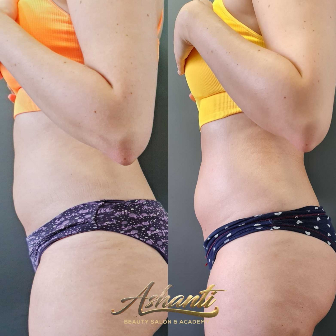 Ashanti Beauty Salon & Academy #beograd Masaža za mršavljenje Dermapen - regija lica