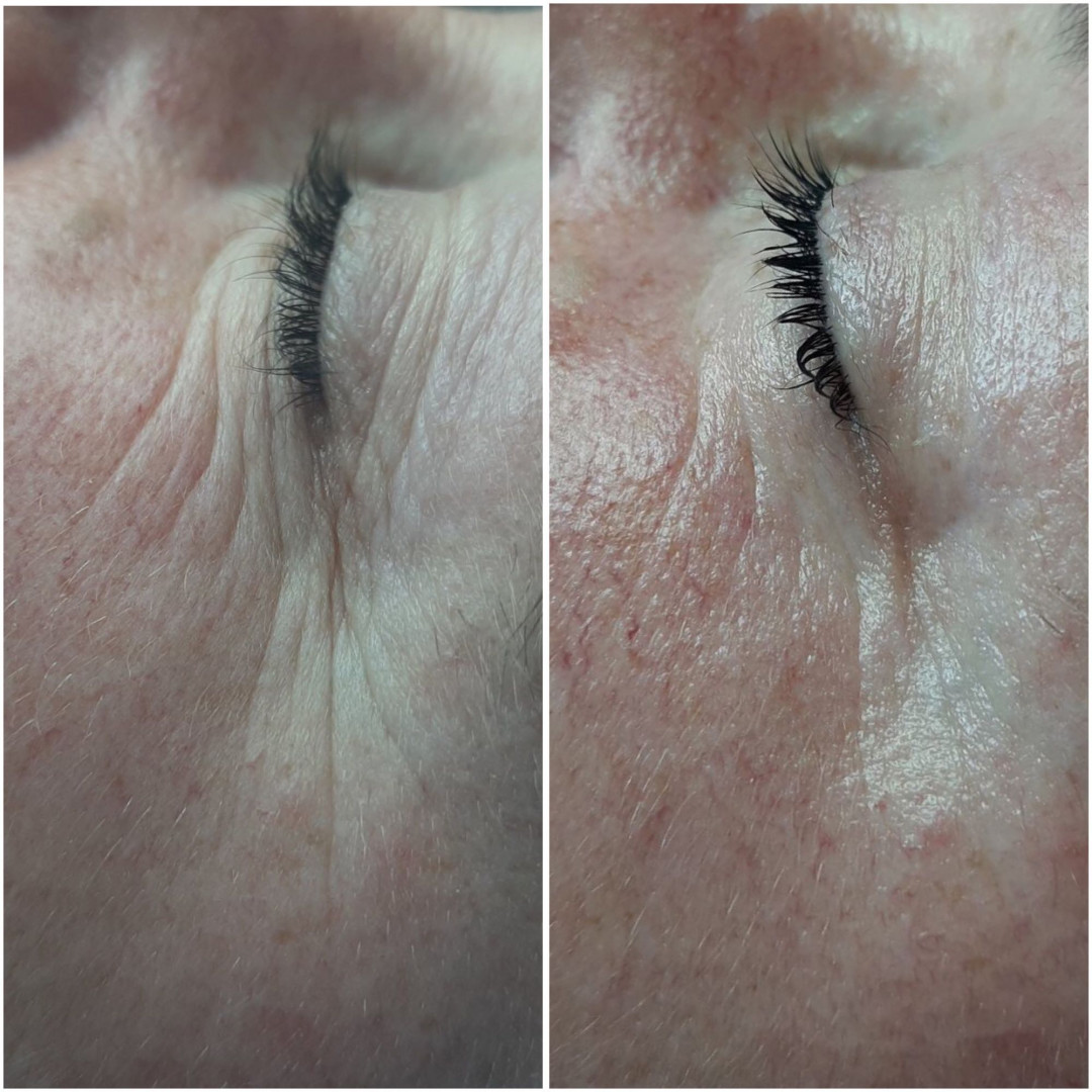 Look at me #beograd Tretman lica Eyelid booster