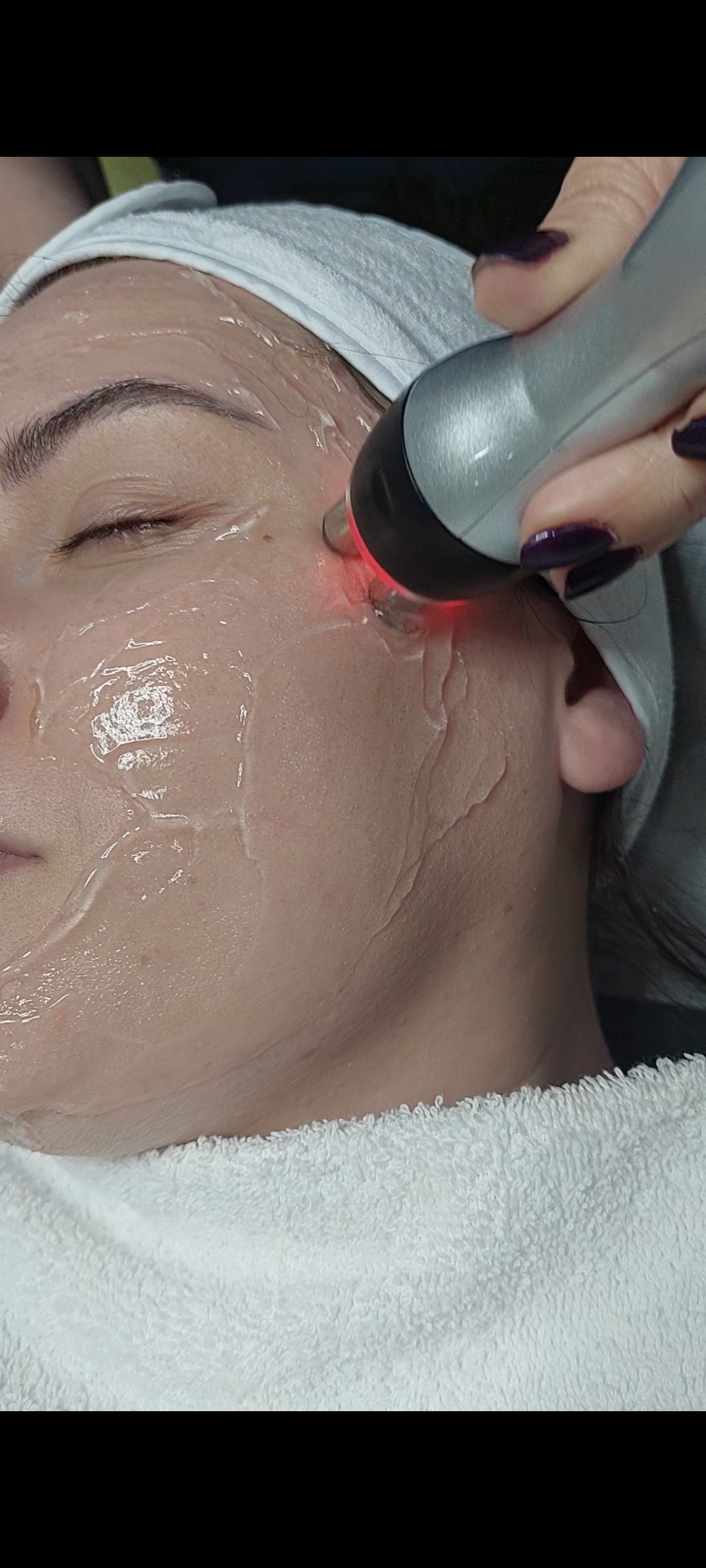 Beauty Palace by M #beograd Radiotalasni i ultrazvučni tretmani RF lica - paket od 2 tretmana + 1 gratis