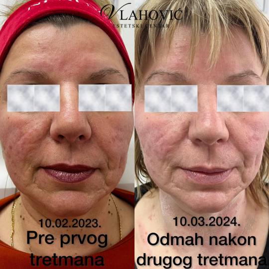 Estetski centar Vlahović #beograd Tretman lica HYDRAFACIAL - regeneracija i rejuvenacija kože Sred