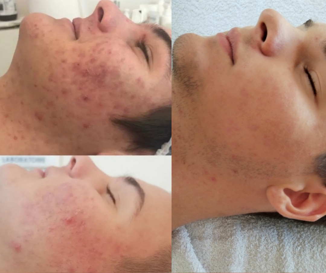 Studio joge i lepote Jelena Bilcar #beograd Tretman lica Mezoterapija + hemijski piling Mesoestetik