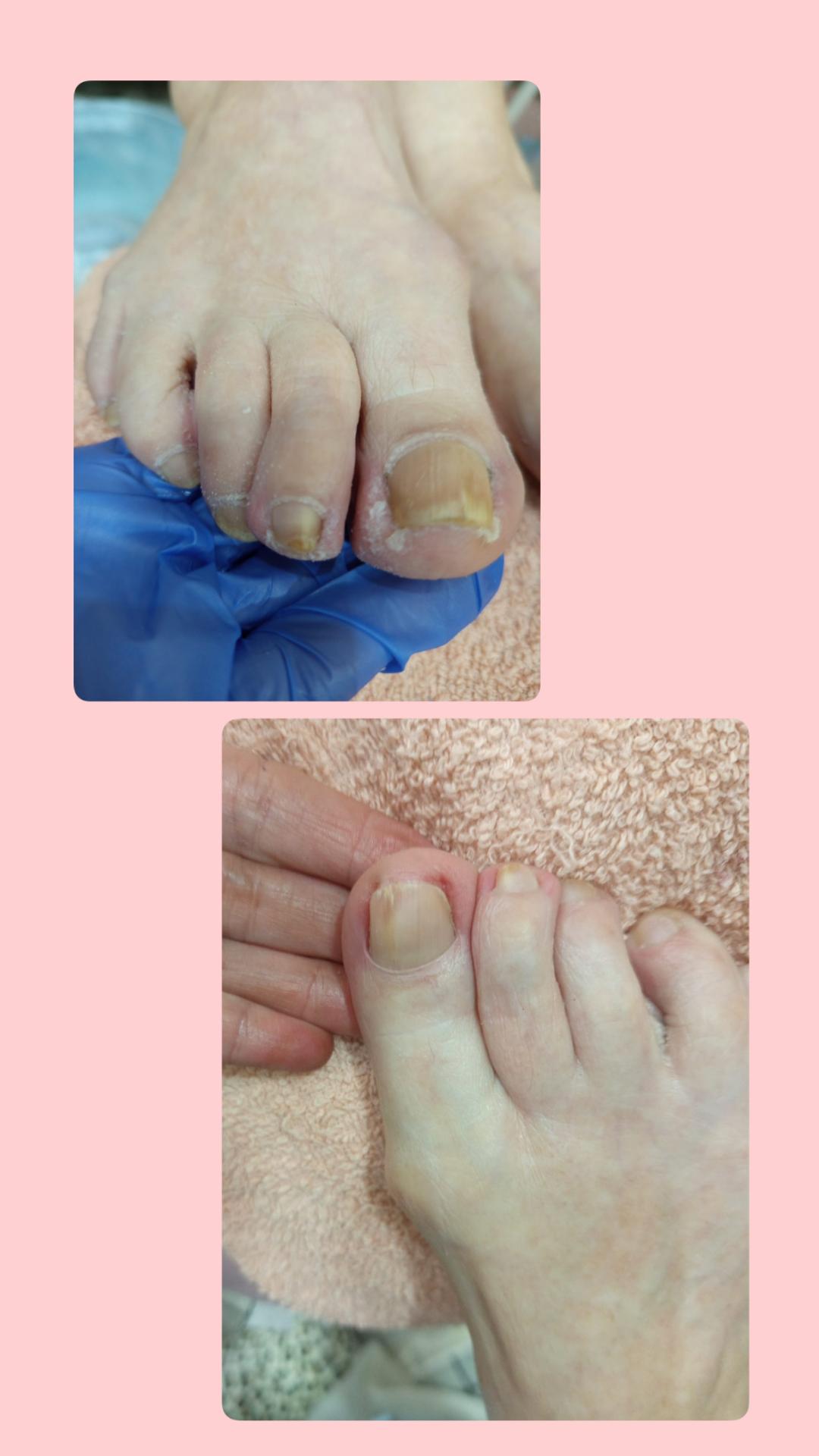 Mira 11 #beograd Medicinski pedikir Medicinski pedikir