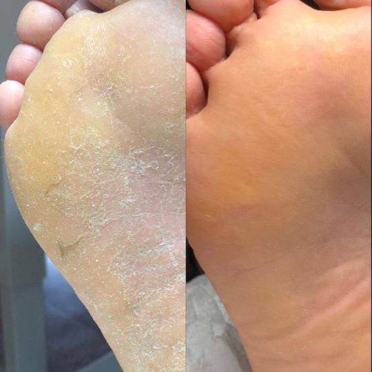 Princess beauty #nis Medicinski pedikir Medicinski pedikir - manje problematičan