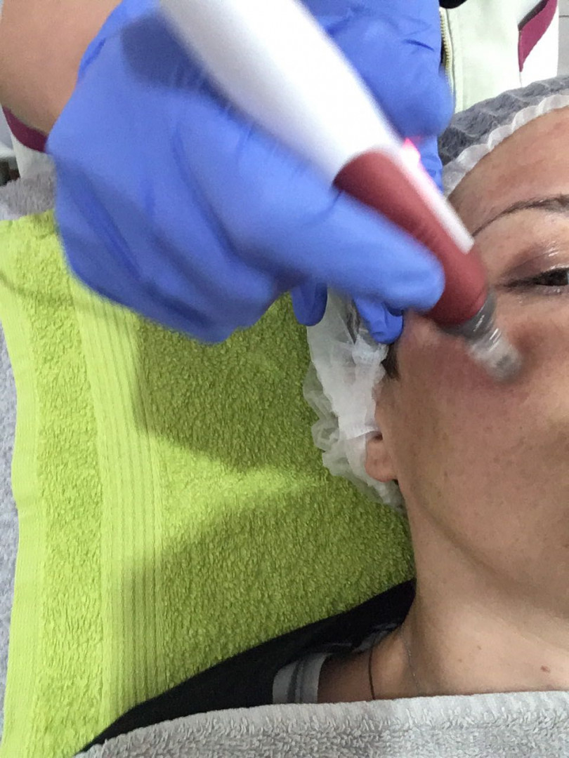 Be You #beograd Dermaroler i dermapen Dermapen tretman lica