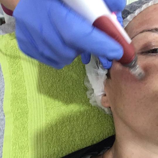 Be You #beograd Dermaroler i dermapen Dermapen tretman lica