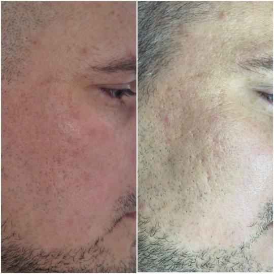 Look at me #beograd Tretman lica Pro lift