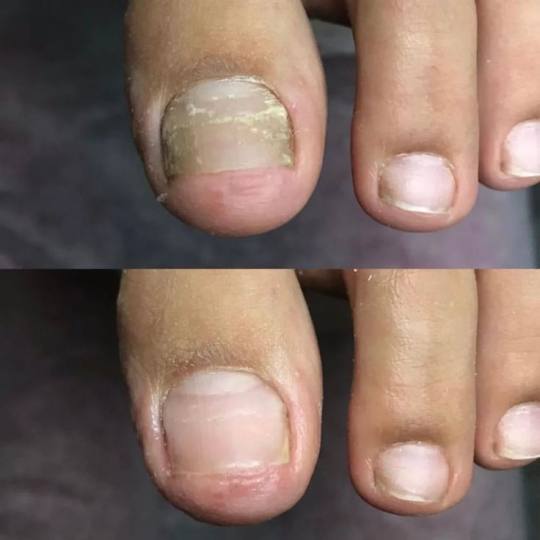 Starmedic #beograd Gljivice na noktima Lasersko uklanjanje gljivica na noktima