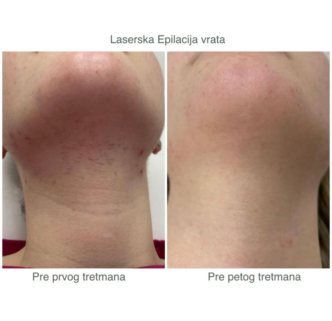 Sylk Wax #jagodina Laserska epilacija Laserska epilacija vrata - za dame
