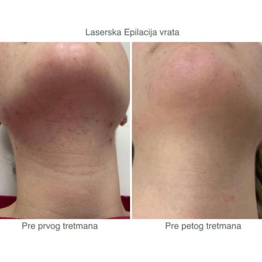 Sylk Wax #jagodina Laserska epilacija Laserska epilacija vrata - za dame