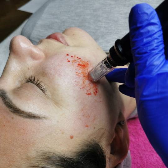 Platinum Beauty Code #beograd Tretman lica Tretiranje ožiljaka od akni dermapenom Mezoperapija derm