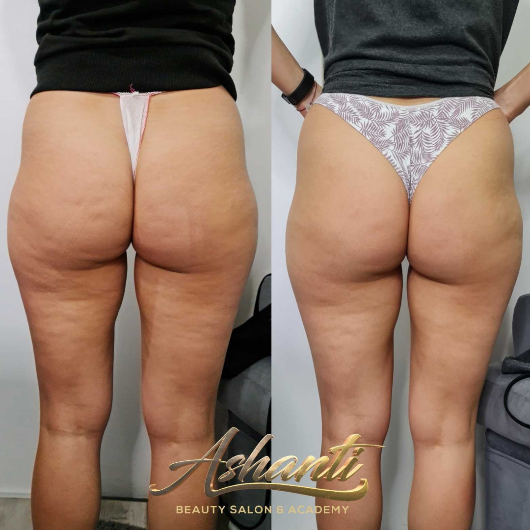 Ashanti Beauty Salon & Academy #beograd Tretmani tela Ultrazvučna kavitacija + radiotalasni lifting - po regiji