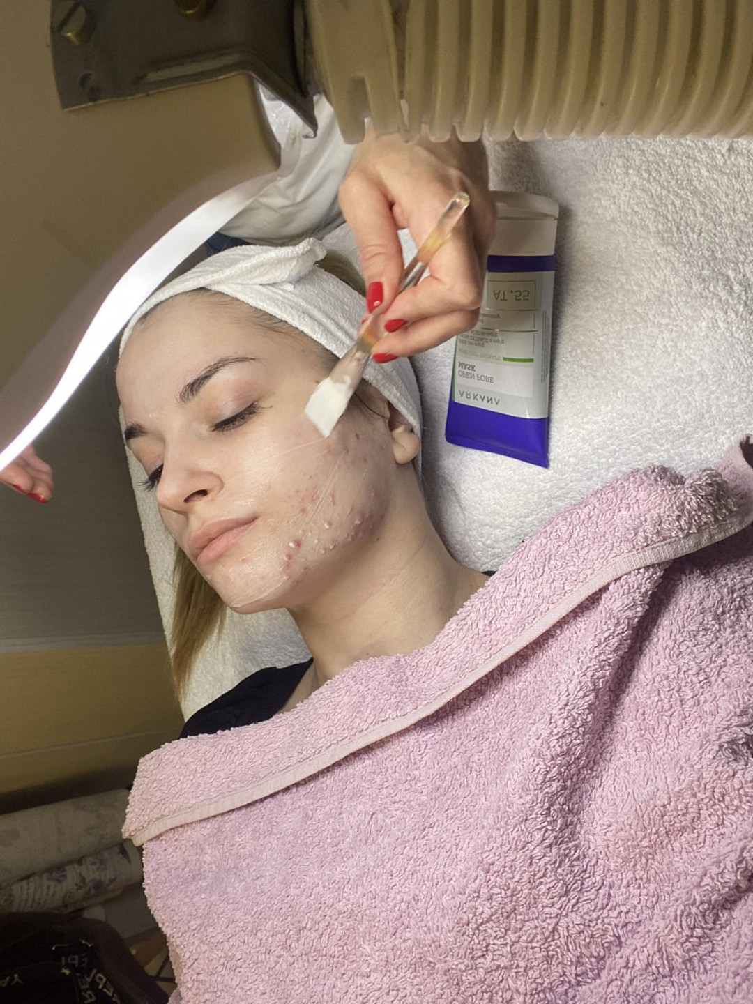 Hemijski piling za akne - Beauty in Style DM, Novi Sad Tretman lica Lice Tretman lica, Novi Sad, Sajmište, Detelinara, Banatić