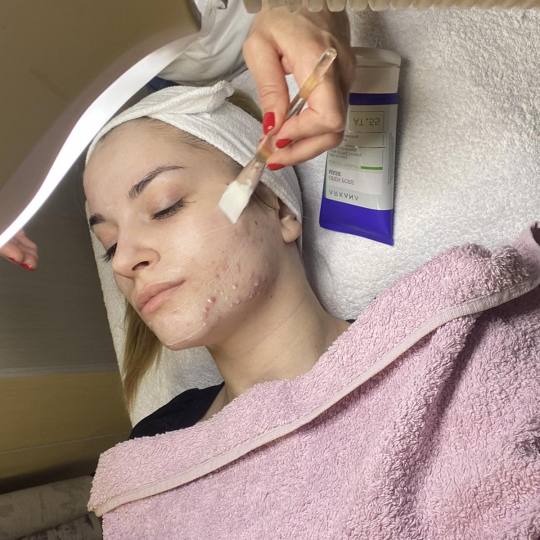 Beauty in Style DM #novisad Tretman lica Hemijski piling za akne