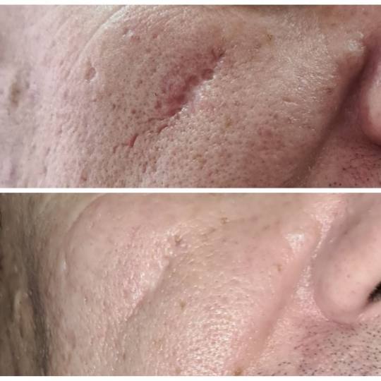 Lancier Beauty Expert #beograd Tretman lica Plazma lift lica - jedna regija