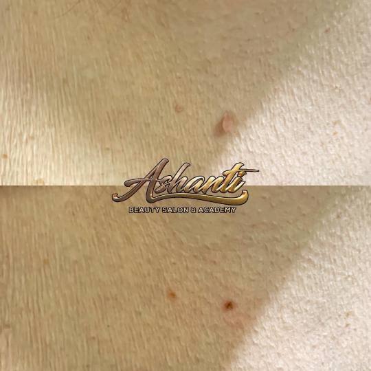 Ashanti Beauty Salon & Academy #beograd Tretman lica Plasma pen - skidanje do 5 bradavica