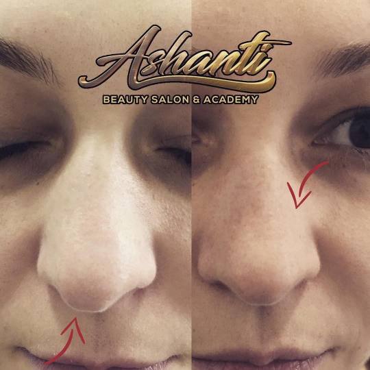 Ashanti Beauty Salon & Academy #beograd Tretman lica Plasma pen - podizanje nosa