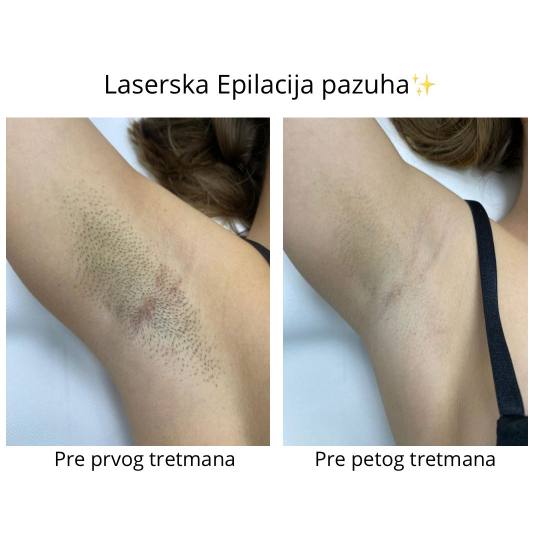 Sylk Wax #jagodina Laserska epilacija Laserska epilacija pazuha - za dame Laserska Epilacija pazuha