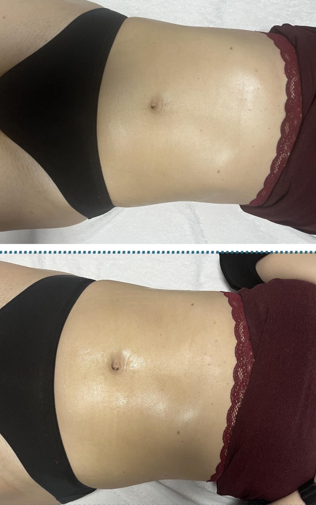 kavitacija/vakum/rf- 30 minuta - Diamond beauty, Beograd Tretmani tela Telo Tretmani tela, Beograd, Zemun Centar