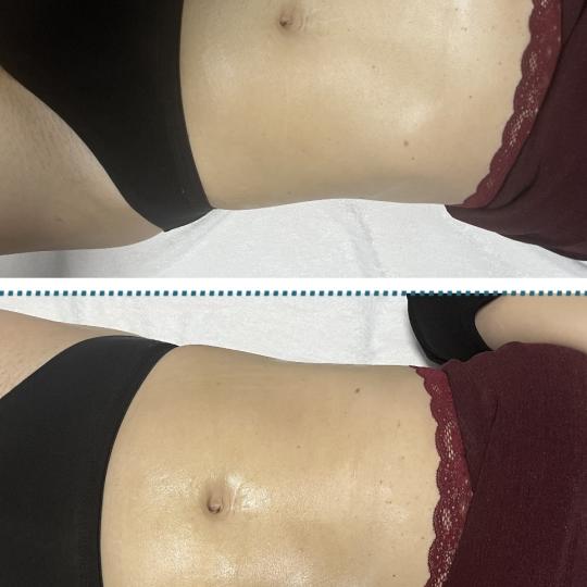 Diamond beauty #beograd Tretmani tela kavitacija/vakum/rf- 30 minuta