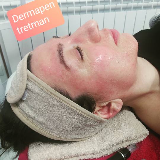 Akademija Stefanović #beograd Dermaroler i dermapen Higijenski tretman + mikrodermoabrazija + derma