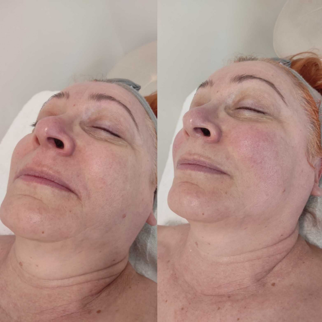 Olja Beauty #beograd Tretman lica Tretman čišćenja lica + fitopiling