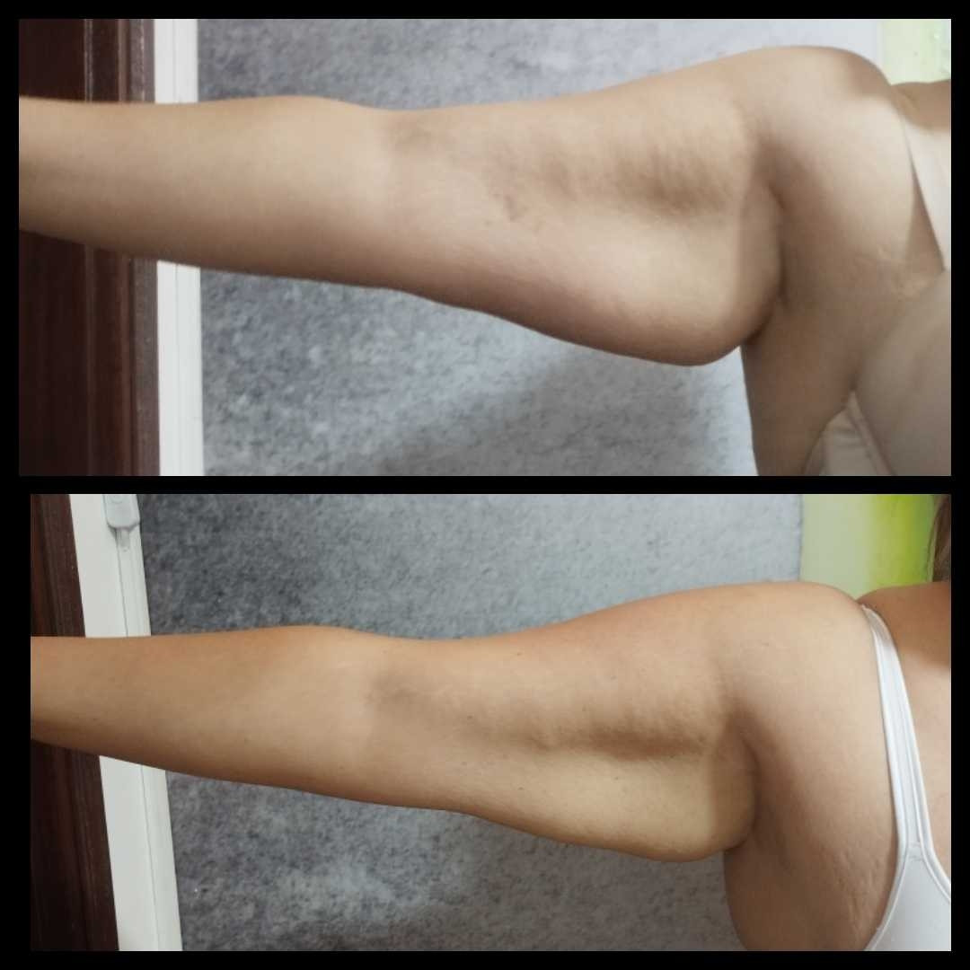 Iva Beauty Lab #beograd Radiotalasni i ultrazvučni tretmani Radiotalasni lifting - ruke