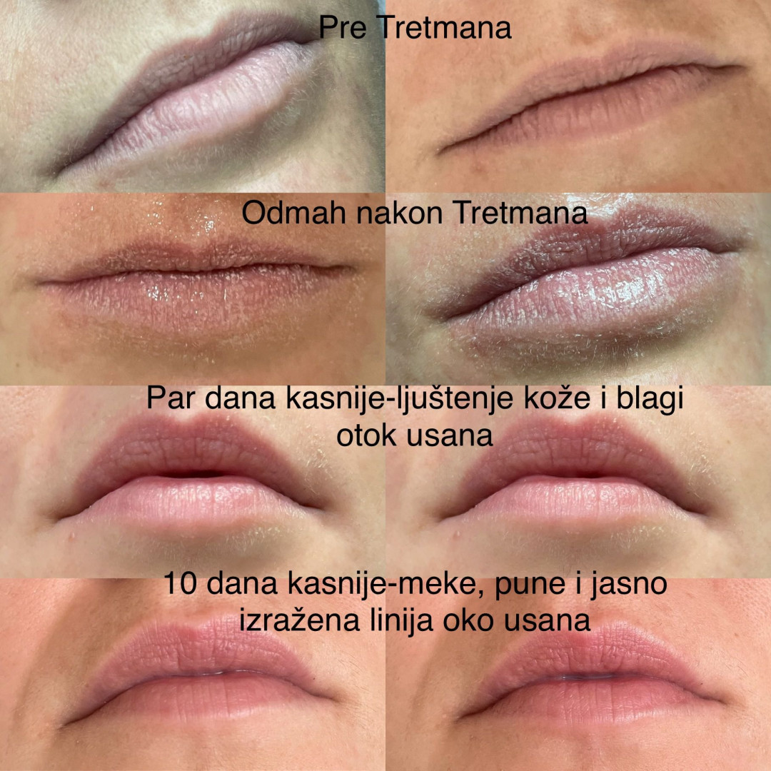 Poliklinika Marić #novisad Tretman lica Laserski tretman usana - rejuvenacija