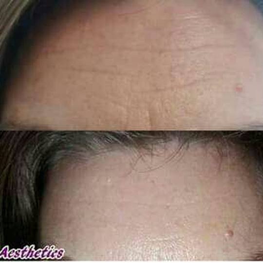 Serenity #beograd Botox Botoksom korigovane bore Botoks jedne regije Botoks je jedan od najpopularni