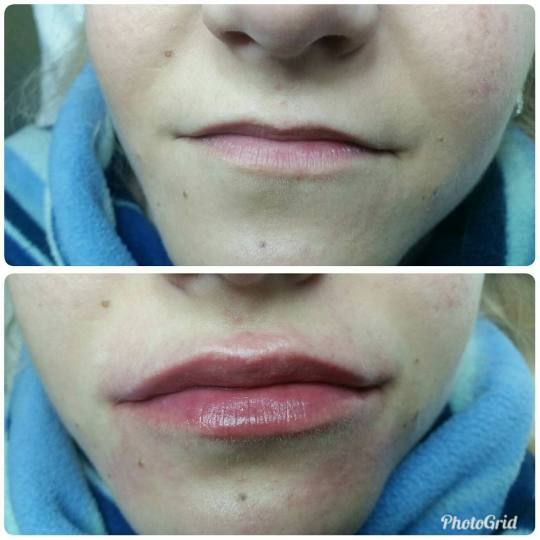 Maximus 1 #nis Hijaluronski tretmani lica Korekcija usana hijaluronskim filerima, 1ml Hijaluronski f