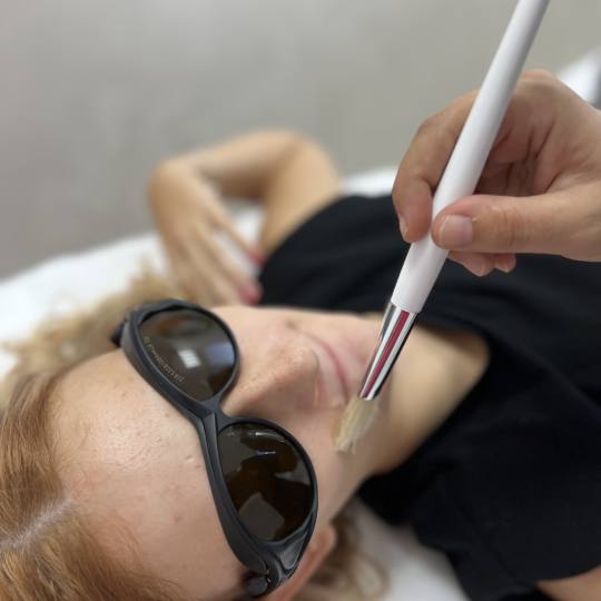 GM Beauty studio #beograd Laserska epilacija Laserska epilacija nausnica - za dame