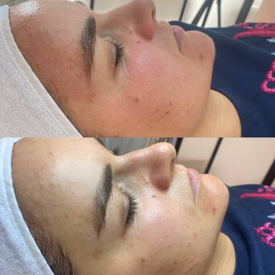 Beauty by Nevena Panić #beograd Tretman lica Hydrafacial tretman lica