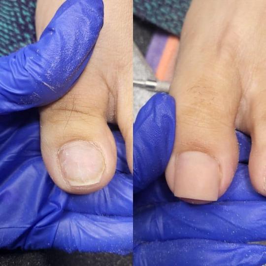 Princess beauty #nis Izlivanje noktiju Rekonstrukcija oštećenih noktiju - izlivanje nokta na palcu