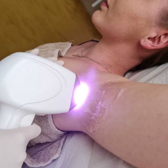 D&D Beauty Center #beograd Laserska epilacija Laserska epilacija pazuha - za dame