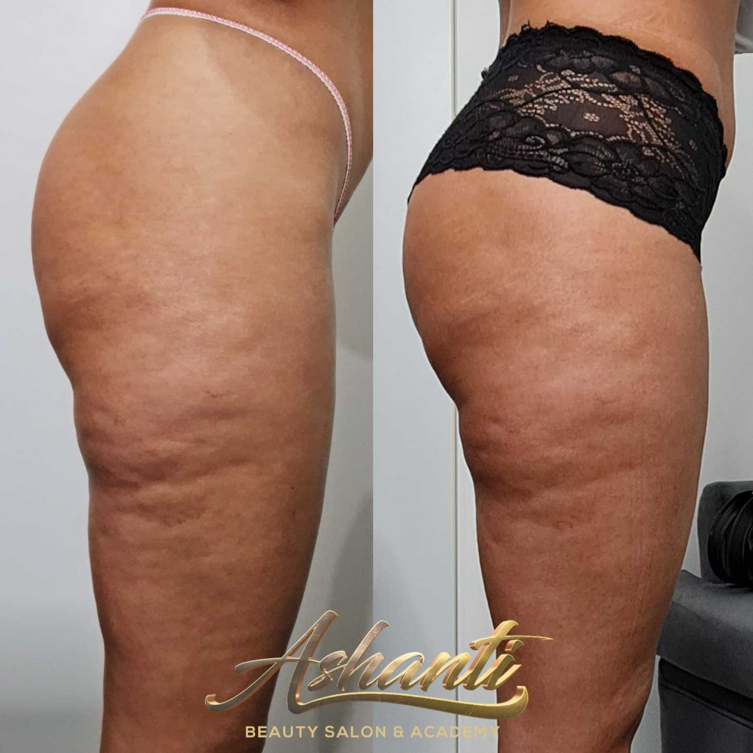 Ashanti Beauty Salon & Academy #beograd Tretmani tela Ultrazvučna kavitacija + radiotalasni lifting - po regiji