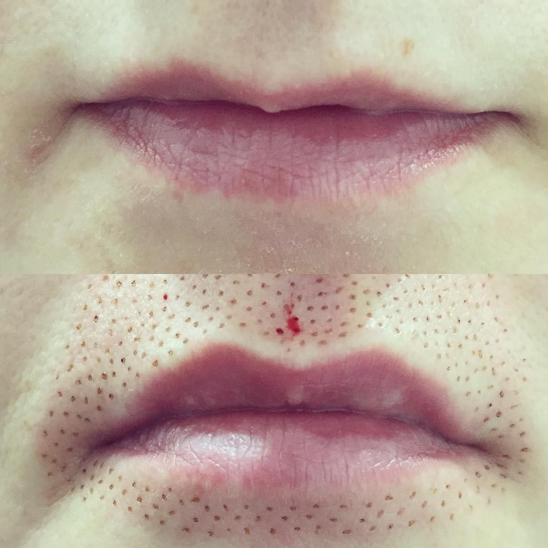 Plasma pen -  lip flip usne - Ashanti Beauty Salon & Academy, Beograd Tretman lica Lice Tretman lica, Beograd, Voždovac