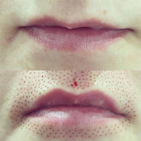 Ashanti Beauty Salon & Academy #beograd Tretman lica Plasma pen -  lip flip usne