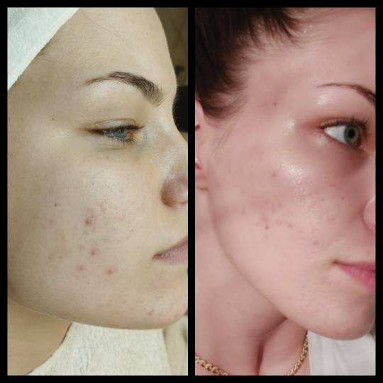 Iva Beauty Lab 2 #beograd Piling lica Hemijski piling AHA kiseline dubinski čiste pore, skidaju pov