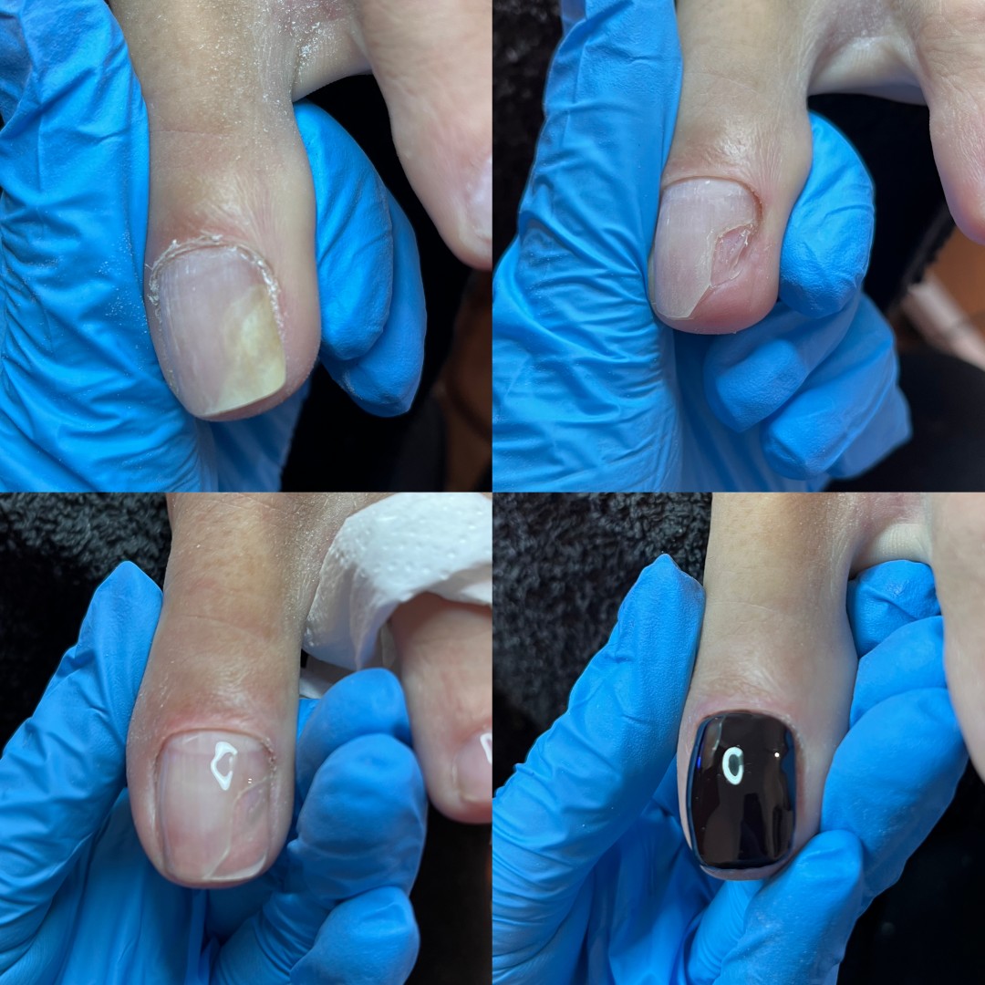 Beauty Derma MKK #beograd Medicinski pedikir Medicinski pedikir - više problematičan