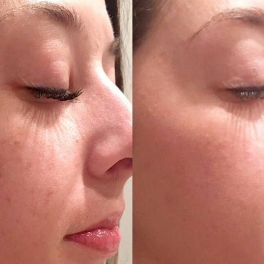 Beauty and me #novisad Tretman lica Mezoterapija (sa dermapenom) - Tretman protiv akni Mezoterapija 