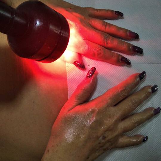 Studio Mima #beograd Tretmani za mršavljenje Uklanjanje fleka - šake Skidanje fleka sa ruku lasero