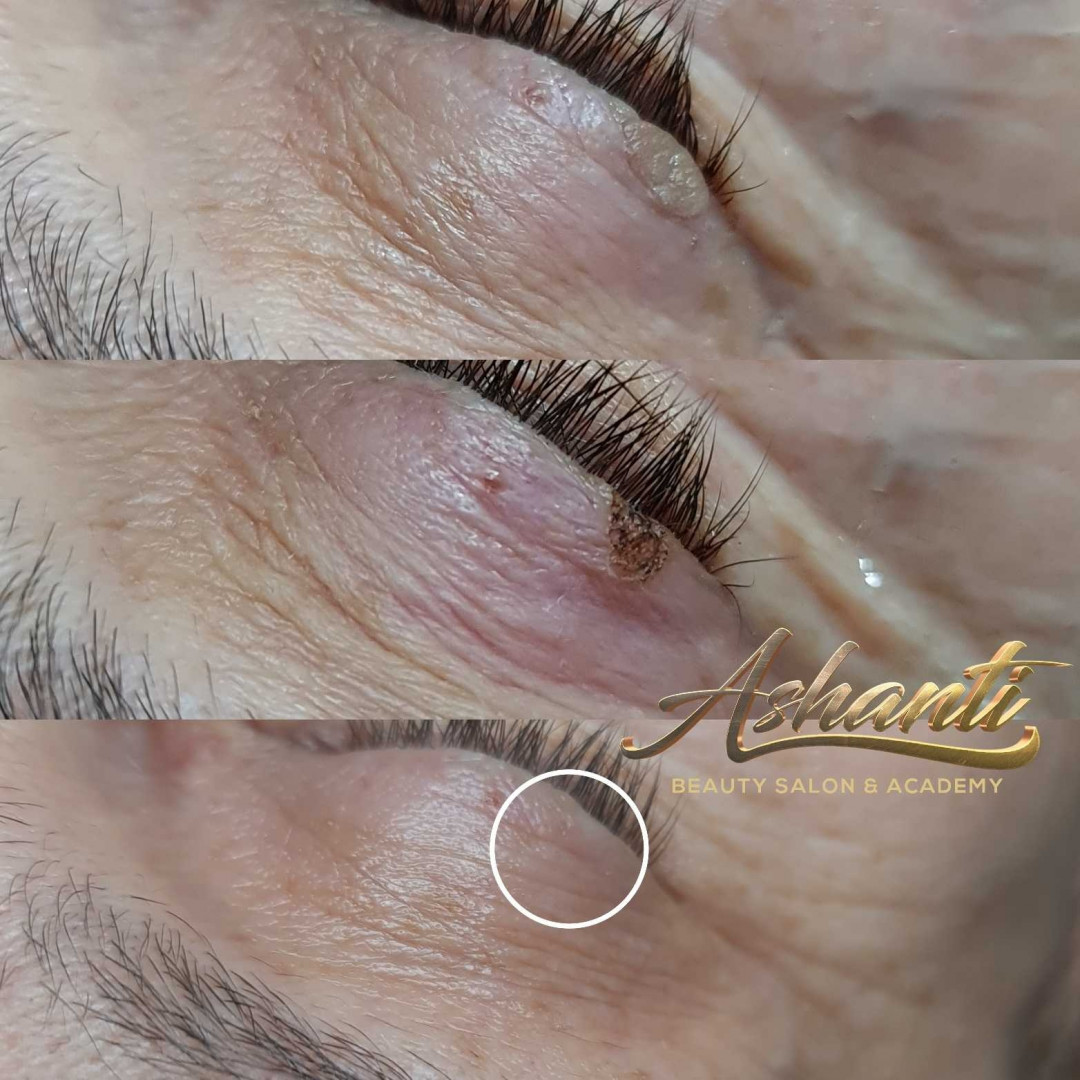 Uklanjanje virusnih bradavica - Ashanti Beauty Salon & Academy, Beograd Tretman lica Lice Tretman lica, Beograd, Voždovac