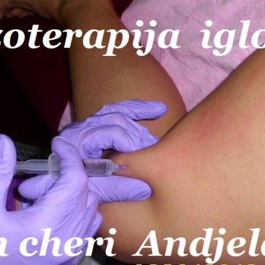 Mon cheri Anđela #beograd Mezoterapija iglom