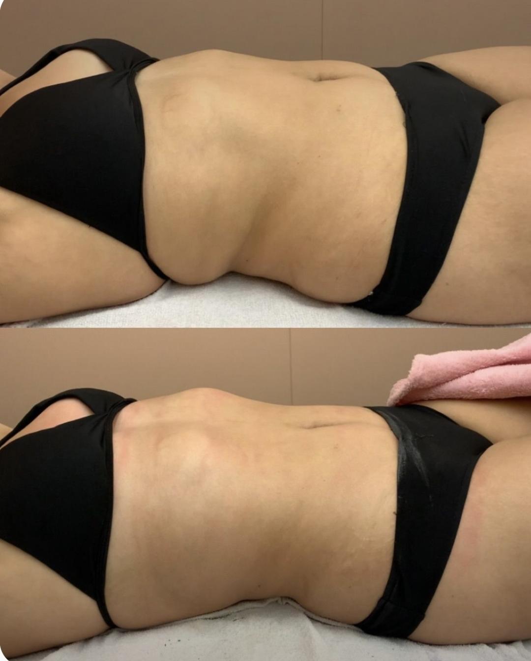 Kavitacija 30min+masaza lipomodelovanje jedne regije - Diamond beauty, Beograd Anticelulit masaža Masaža Anticelulit masaža, Beograd, Zemun Centar