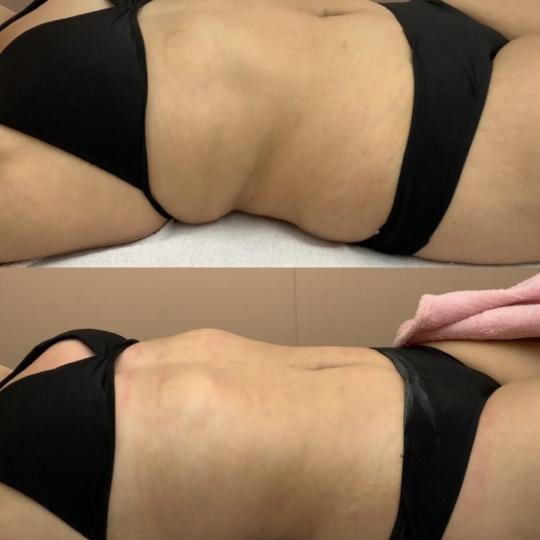 Diamond beauty #beograd Anticelulit masaža Kavitacija 30min+masaza lipomodelovanje jedne regije