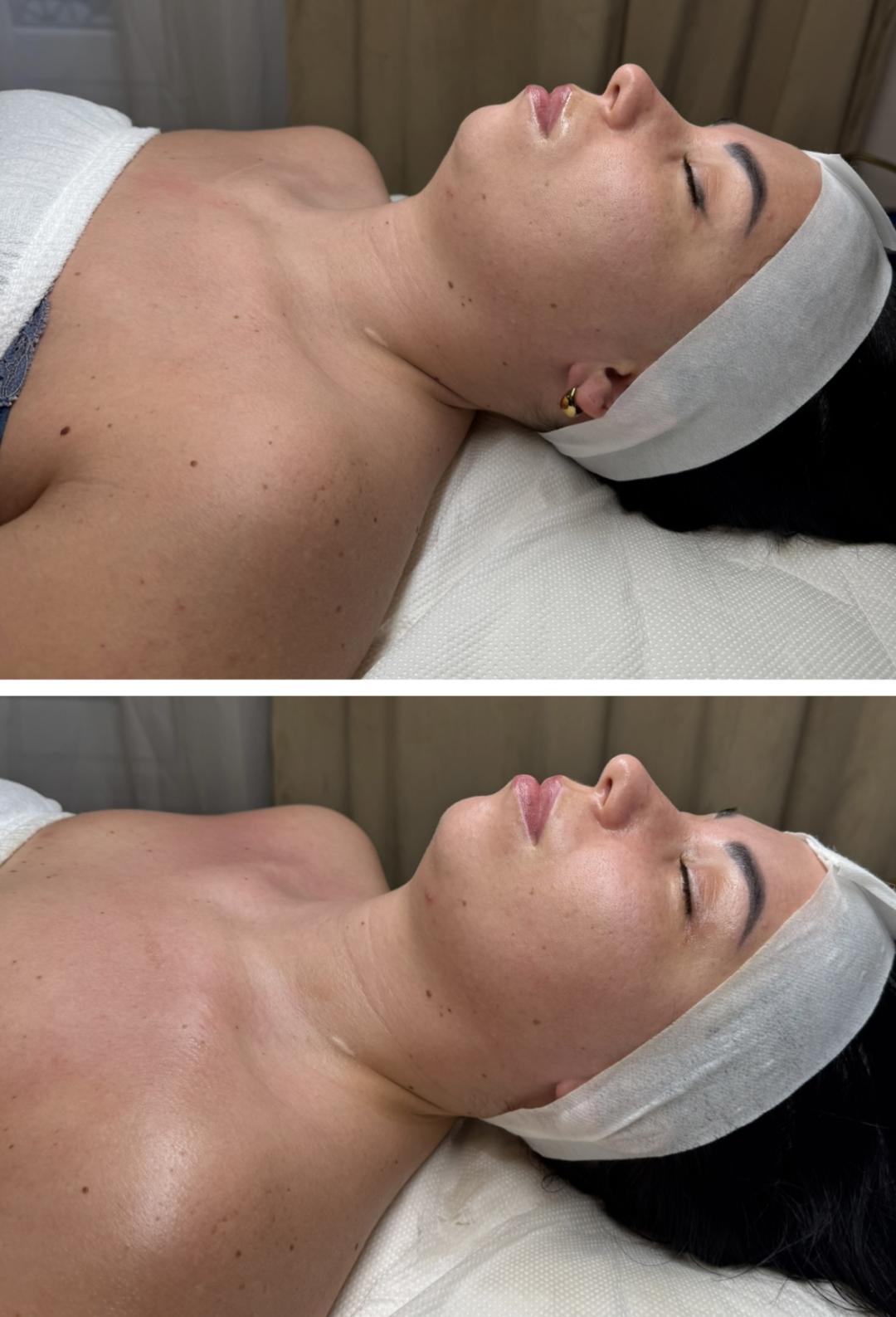 Beauty and nutrition #beograd Lifting / zatezanje kože DIVINE Face masaža lica po metodi Manuele Shale