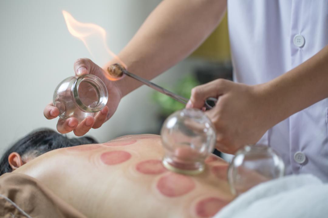 Biorelaks centar #novisad Alternativna medicina Cupping - Suva Hidžama Ventuze